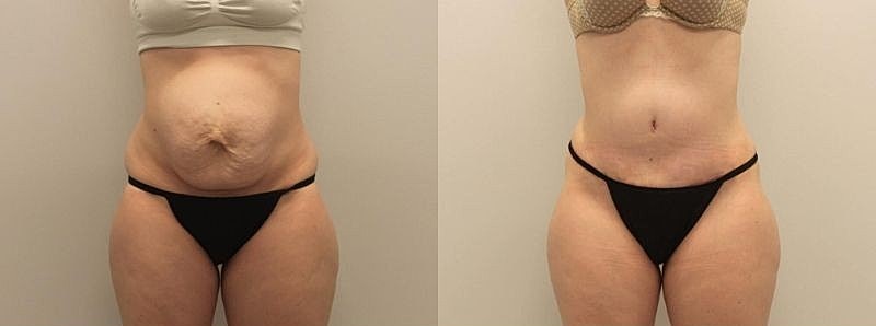 Antes e depois