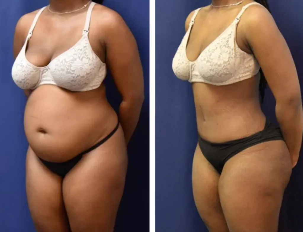 Antes e depois