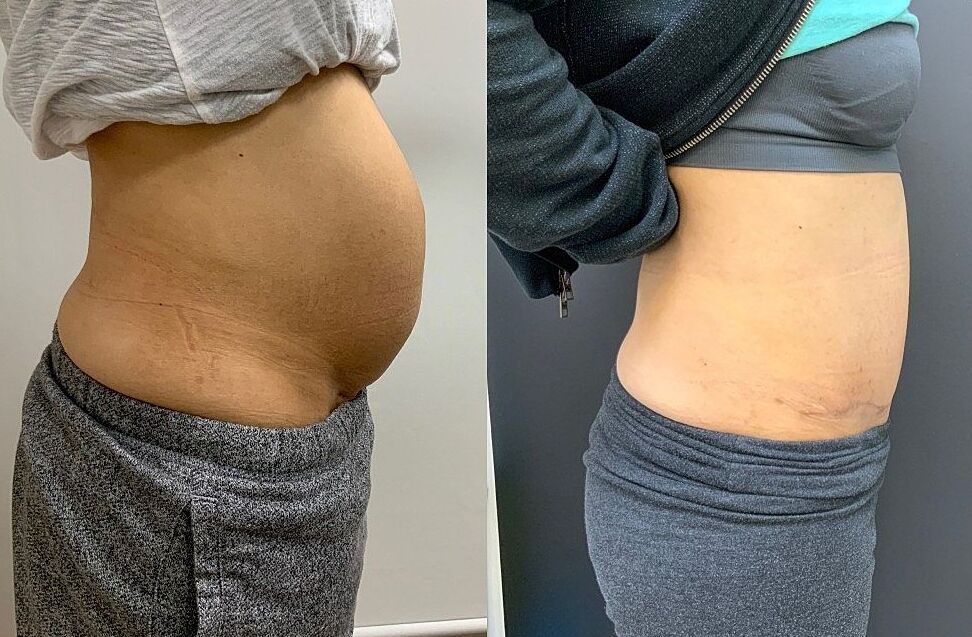 Antes e depois